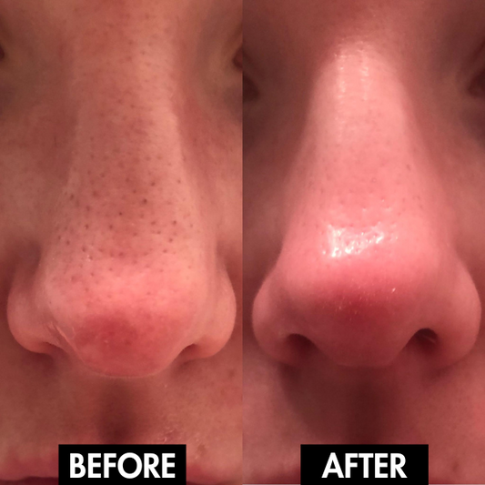 PureGlow™ Electric Pore Vacuum