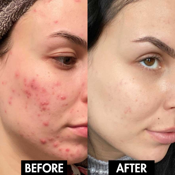 PureGlow™ Electric Pore Vacuum